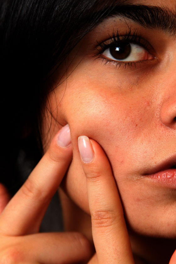 Acne Skin Disorders
